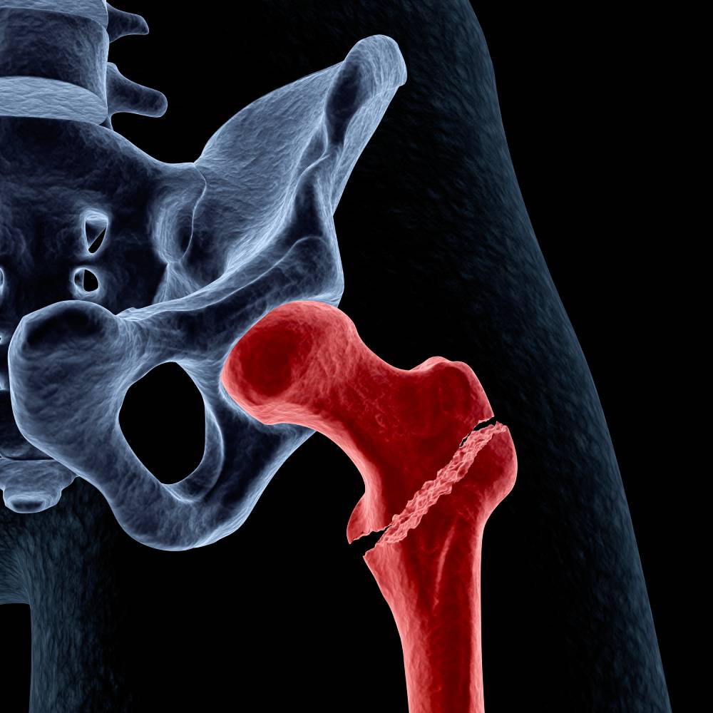 supplements to heal broken bones